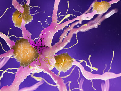 New Study Suggests THC and CBD Could Help Treat Agitation in Dementia Patients